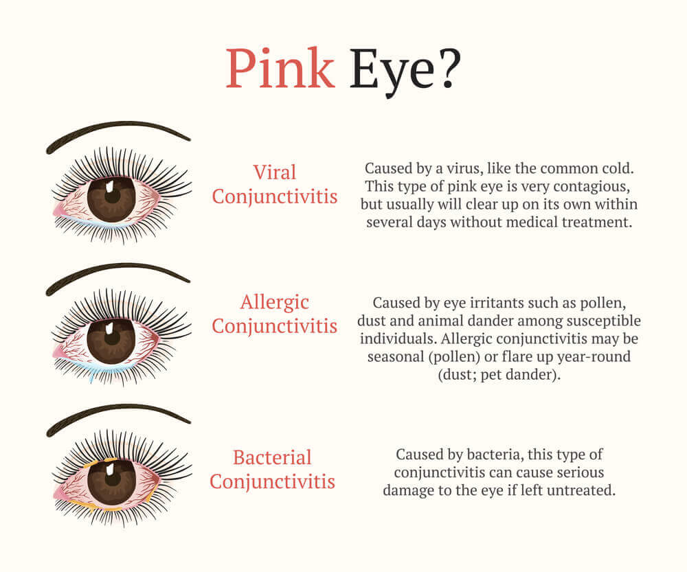 Eye Allergies vs. Allergic Conjunctivitis vs. Pink Eye What's the ...